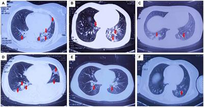 A mass event of paraquat poisoning via inhalation
